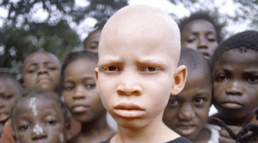 Почему идет охота на альбиносов. Кровавая охота на альбиносов. Статистика альбинизма в Танзании